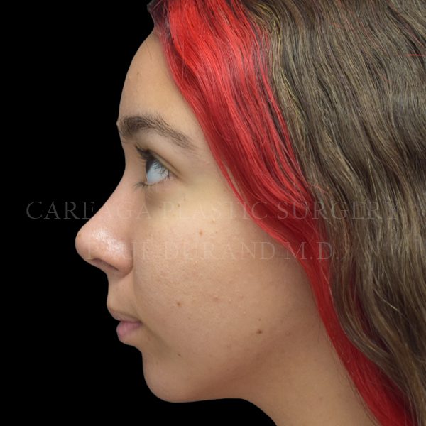 Rhinoplasty case 012 after, view 2