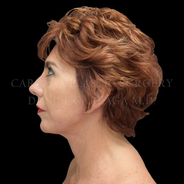 Facelift case 007 after, view 2