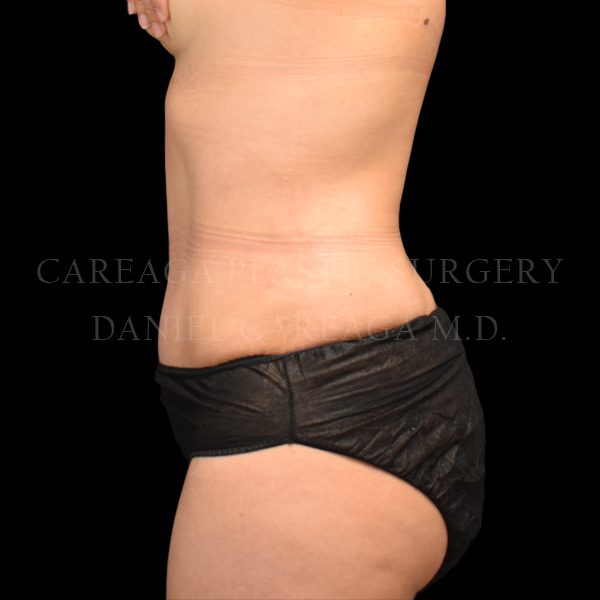Tummy Tuck case 026 after, view 2
