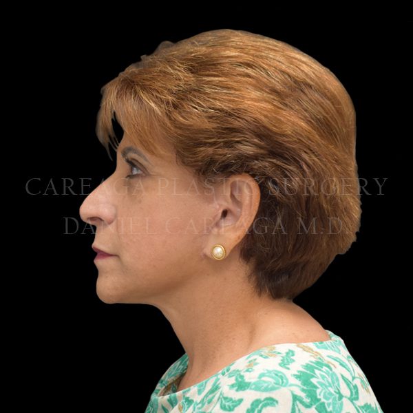 Facelift case 008 after, view 2