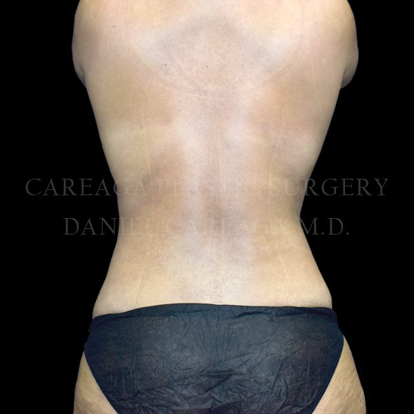 Liposuction case 011 after, view 2