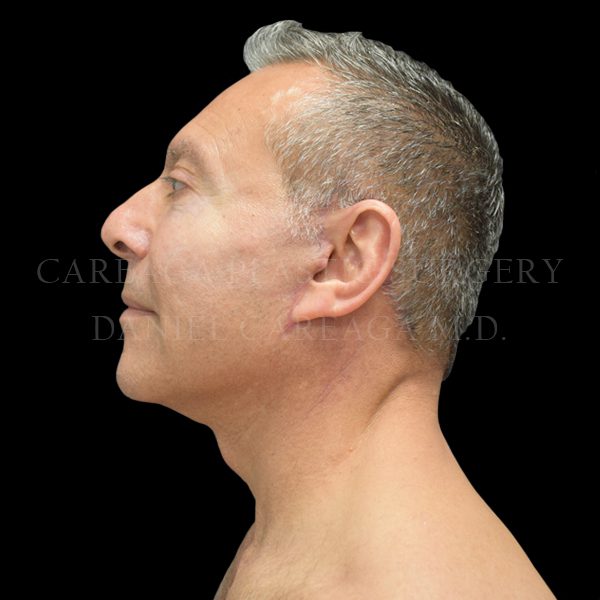 Facelift case 009 after