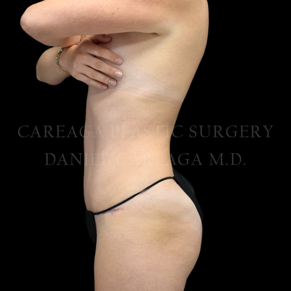Tummy Tuck case 027 after, view 2