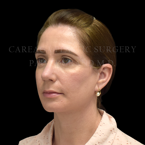 Rhinoplasty case 015 after, view 2