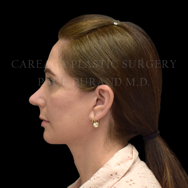 Rhinoplasty case 015 after