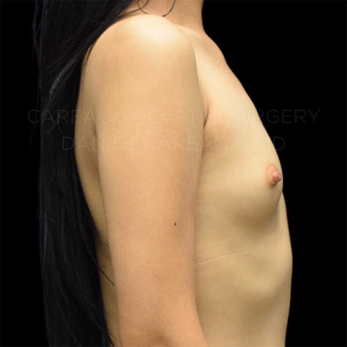 Breast-Augmentation-Case--6045 | Before Breast Augmentation