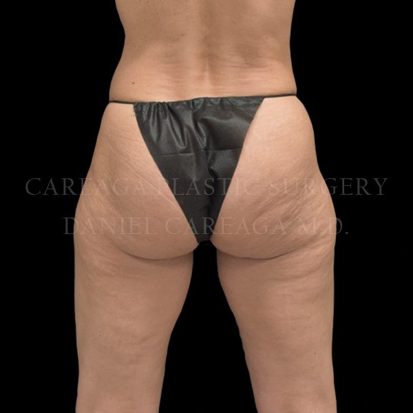 Cellulaze-case-001 | Before Cellulaze