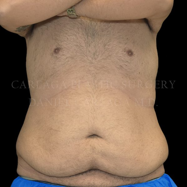 Tummy Tuck case 023 before