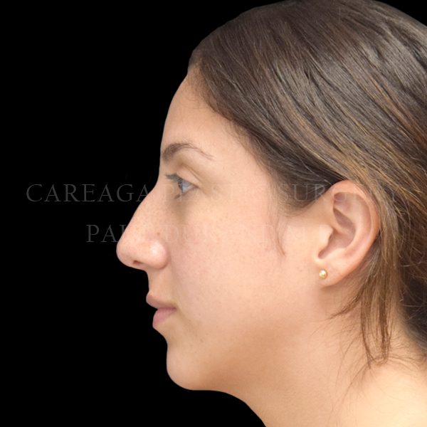 Rhinoplasty case 008 before