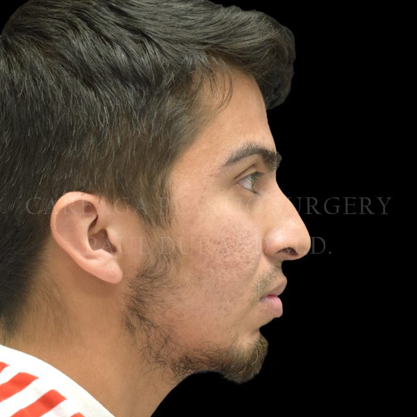 Rhinoplasty case 007 before