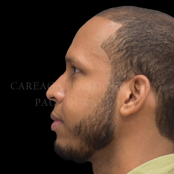 Rhinoplasty case 009 before