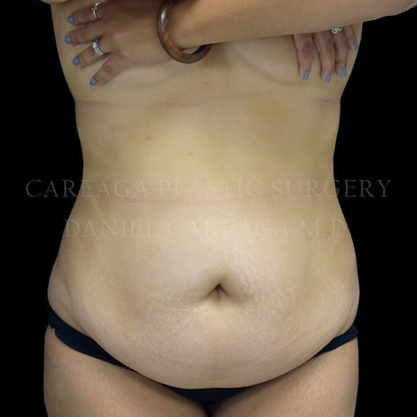 Tummy Tuck case 024 before