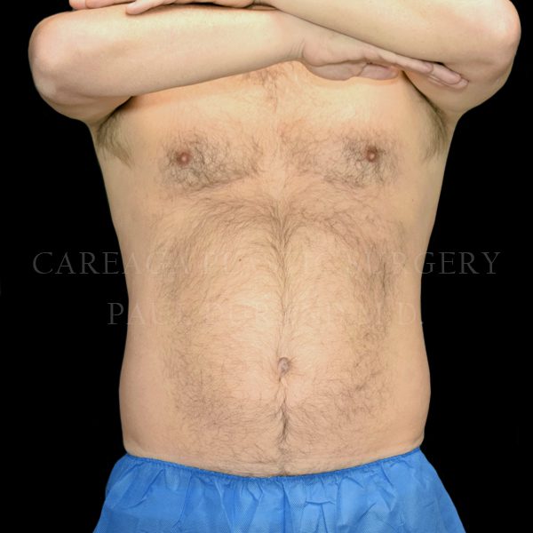 Liposuction case 007 before