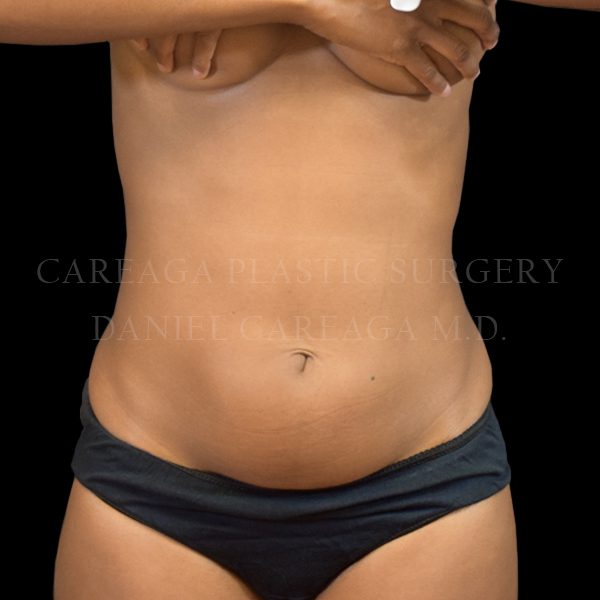 Liposuction case 008 before