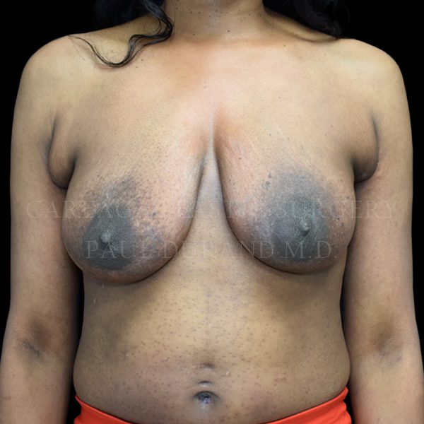 Breast Lift case 005 before