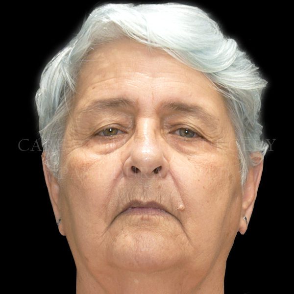 Blepharoplasty-case-001 | Before Blepharoplasty