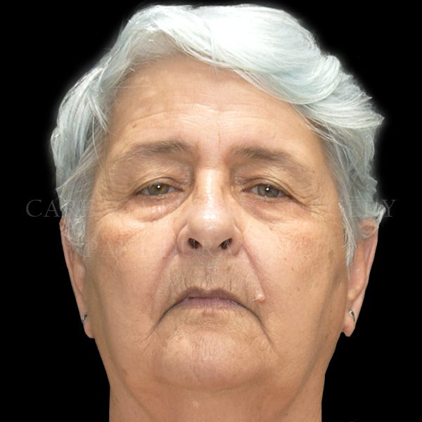 Blepharoplasty case 001 before