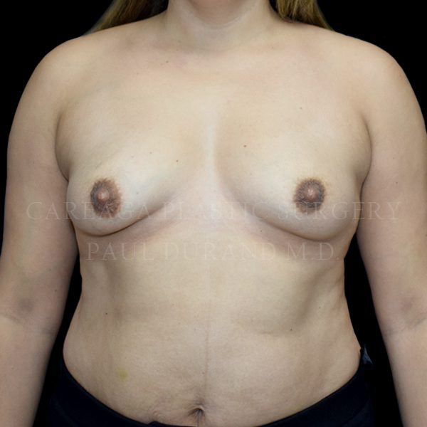Breast Augmentation case 018 before