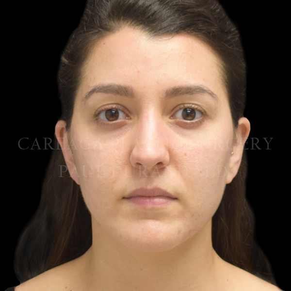 Rhinoplasty case 010 before