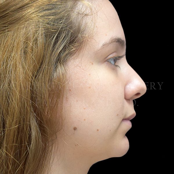 Chin Implant case 001 before