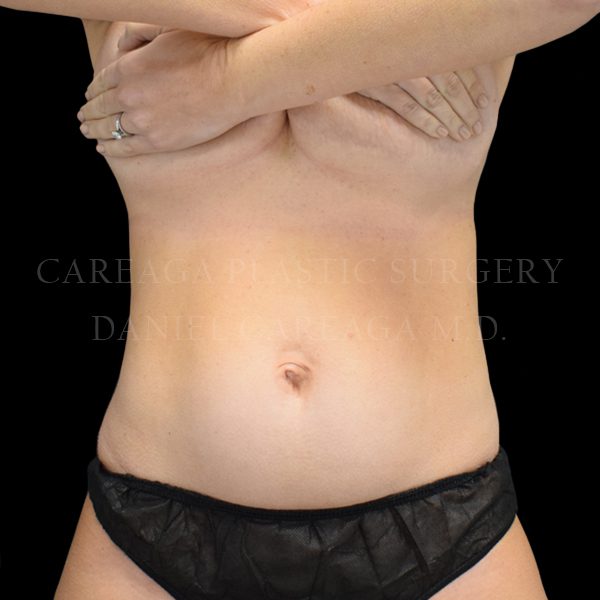 Tummy Tuck case 025 before