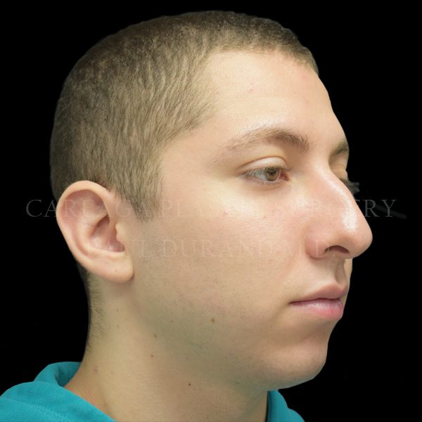 Rhinoplasty case 011 before