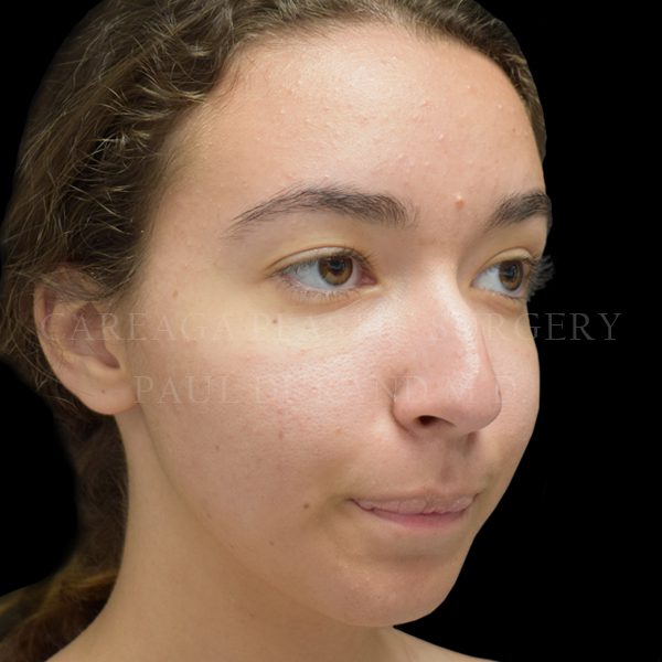 Rhinoplasty case 012 before