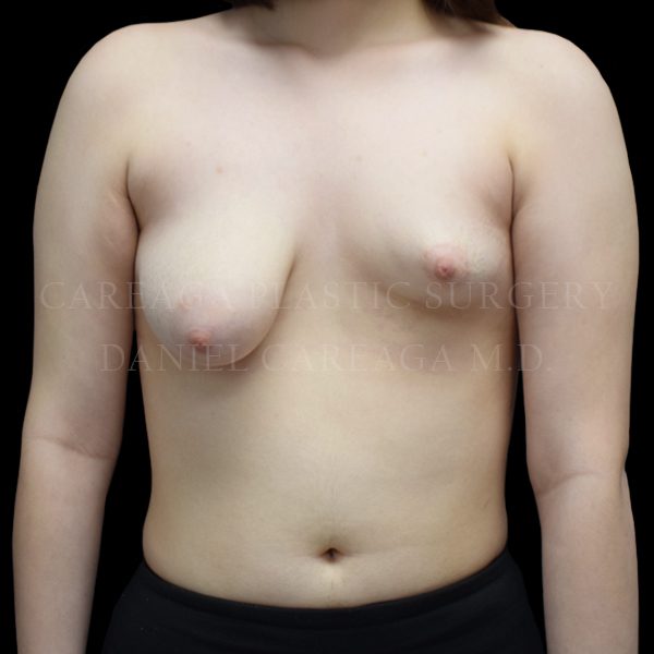 Breast Lift with Implants case 008 before