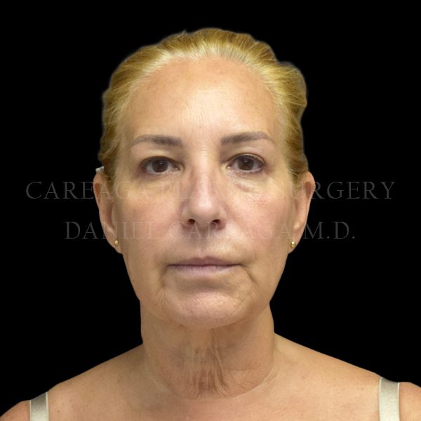 Facelift case 006 before