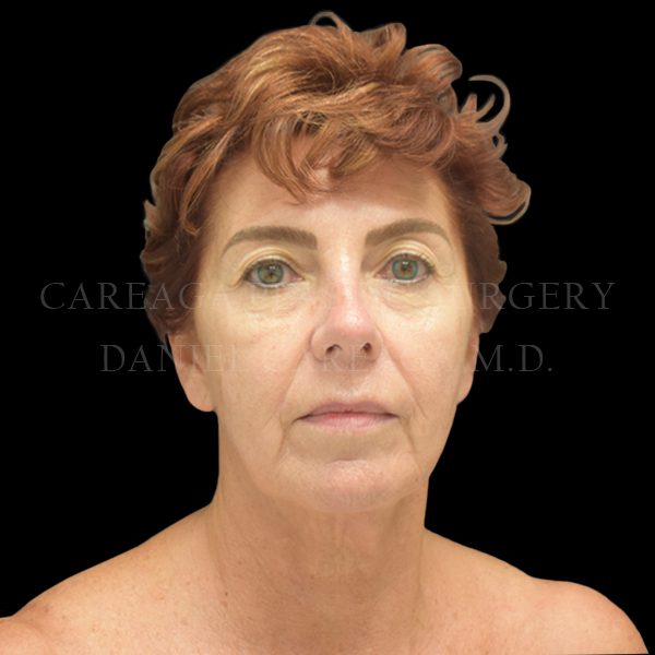 Facelift case 007 before