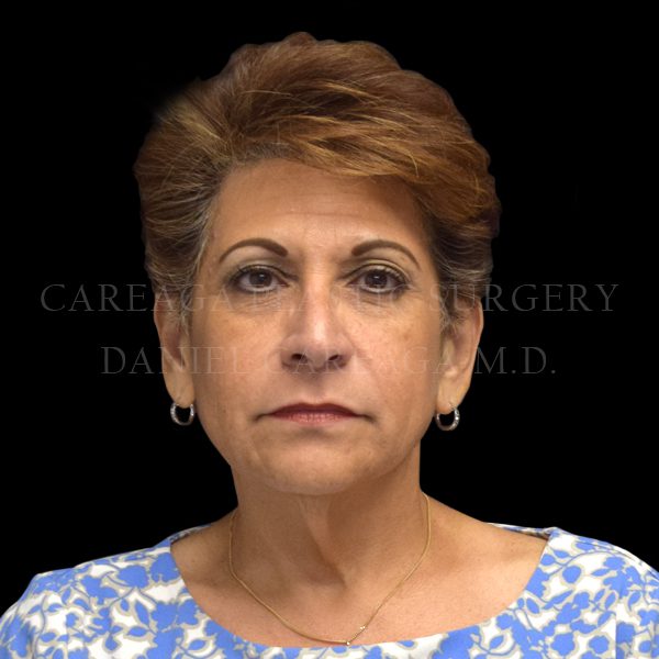 Facelift case 008 before