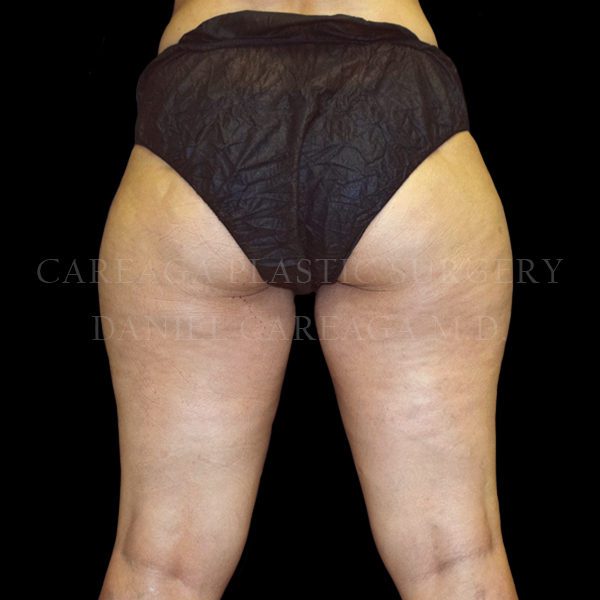 Cellulaze-case-002 | Before Cellulaze