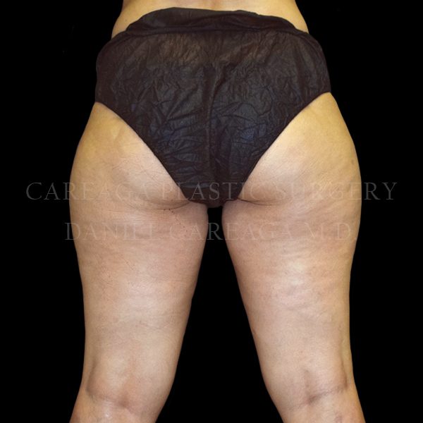 Cellulaze case 002 before