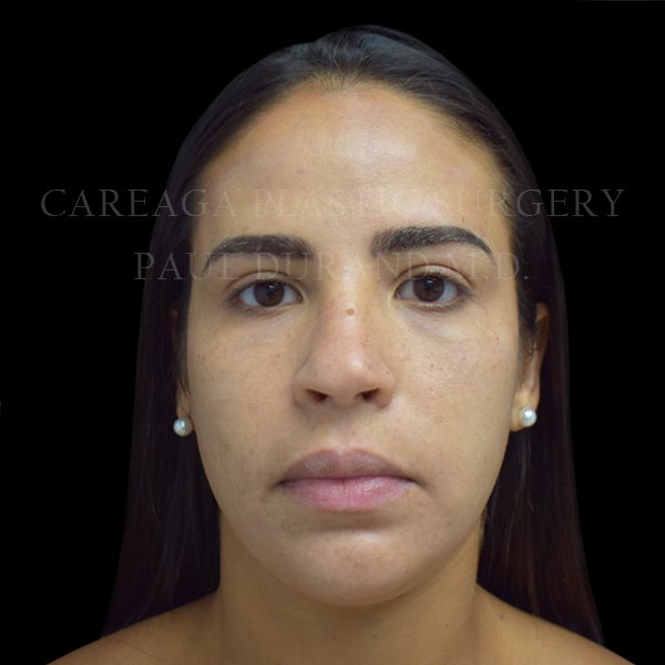 Rhinoplasty case 013 before