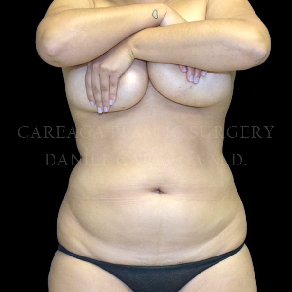 Liposuction case 011 before