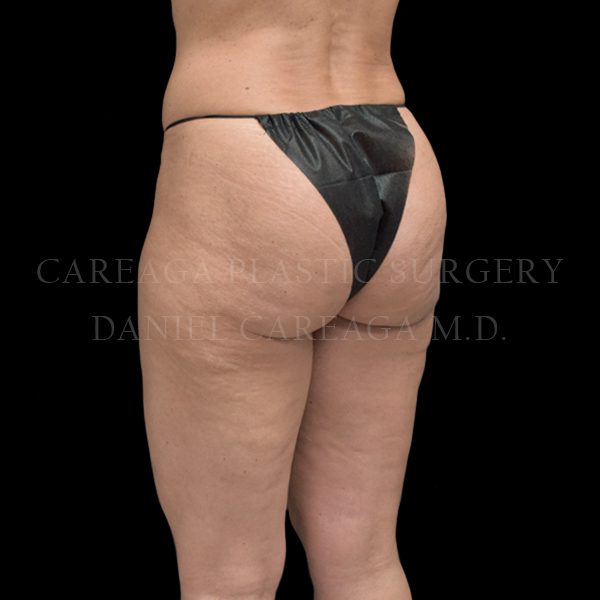 Cellulaze case 001 before, view 2