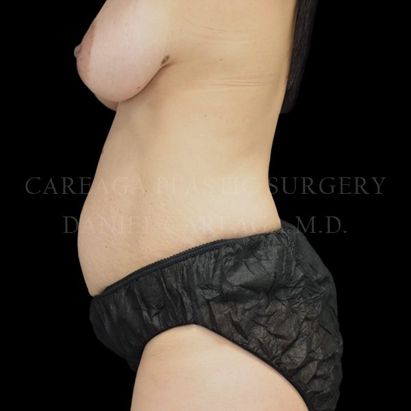 Tummy Tuck case 022 before, view 2