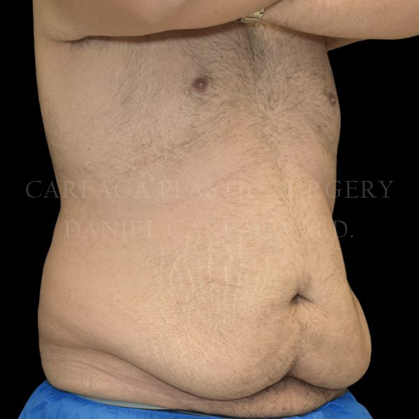 Tummy Tuck case 023 before, view 2