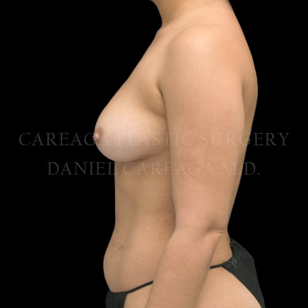 Breast Augmentation case 016 before, view 2