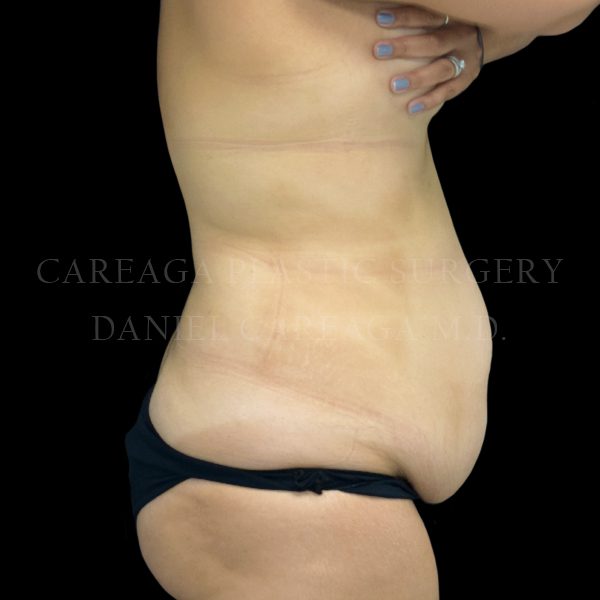 Tummy Tuck case 024 before, view 2