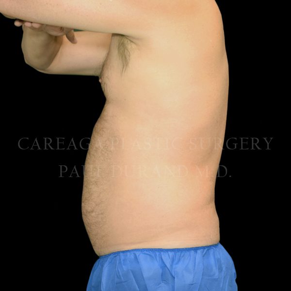 Liposuction case 007 before, view 2