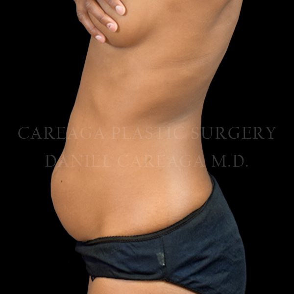 Liposuction case 008 before, view 2