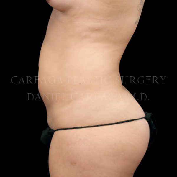 Liposuction case 009 before, view 2