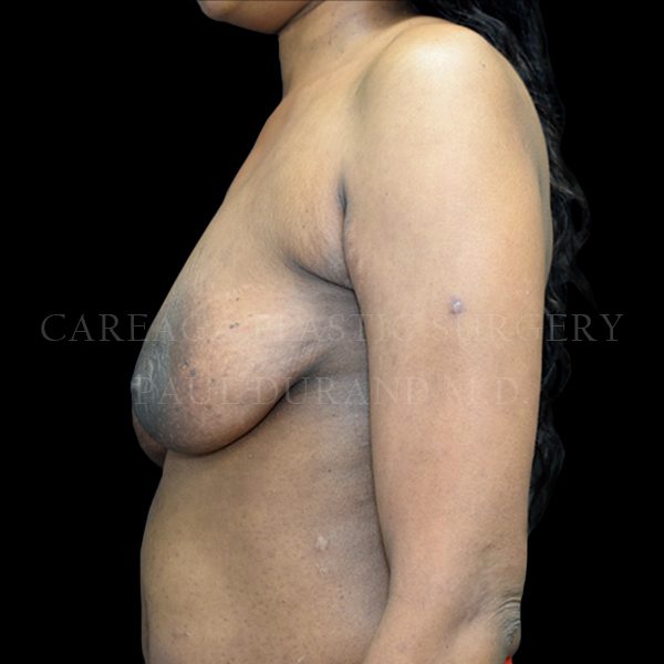 Breast Lift case 005 before, view 2