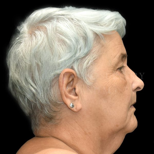 Blepharoplasty case 001 before, view 2