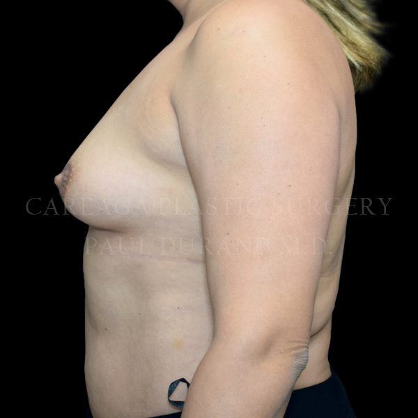 Breast Augmentation case 018 before, view 2