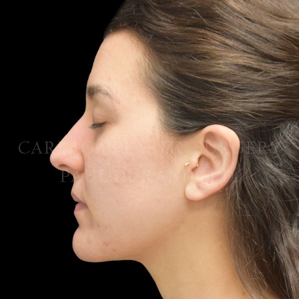 Rhinoplasty case 010 before, view 2