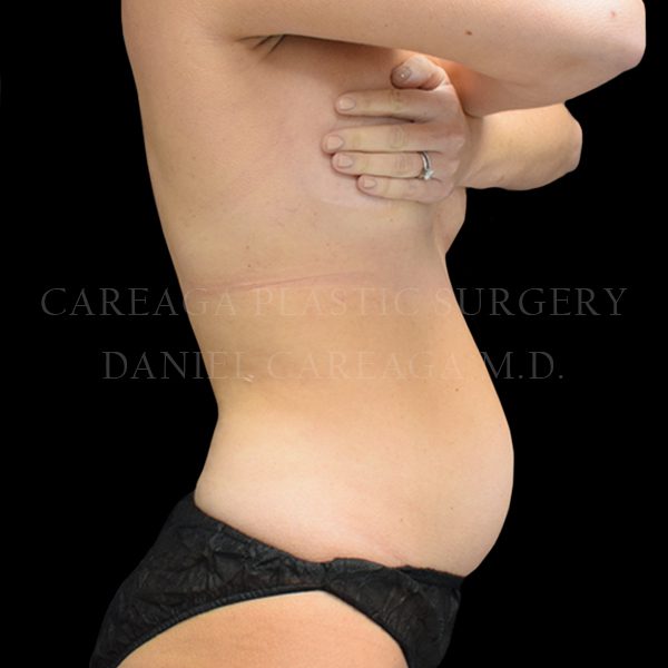 Tummy Tuck case 025 before, view 2