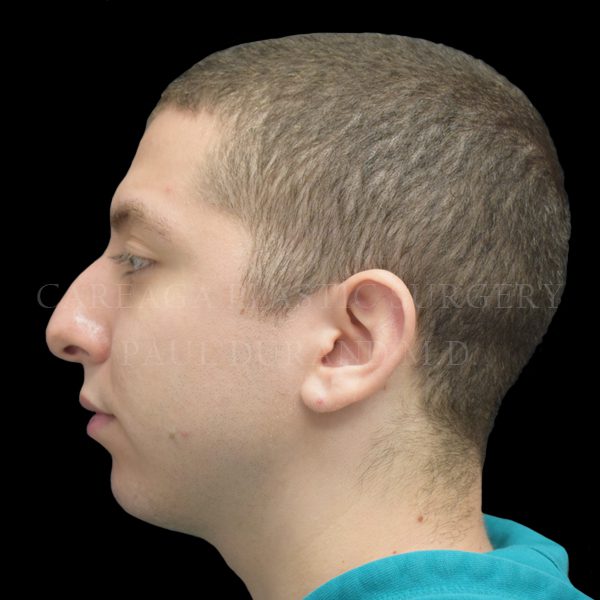 Rhinoplasty case 011 before, view 2