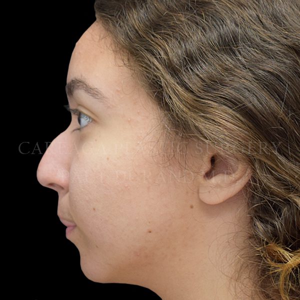 Rhinoplasty case 012 before, view 2